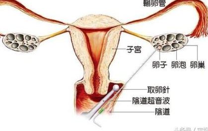 为何泰国试管婴儿费用远高于国内？