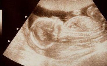 2026年未婚单身前往徐州做试管要准备多少钱？十五万够吗？